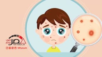 الجدري المائي.. مخاطر ووقاية وعلاج (إنفوجراف)